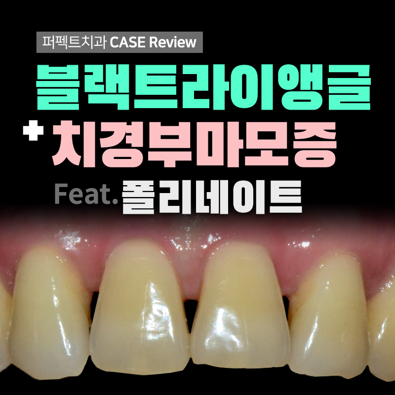 블랙트라이앵글, 치경부마모증 치과치료! 관련 이미지 1