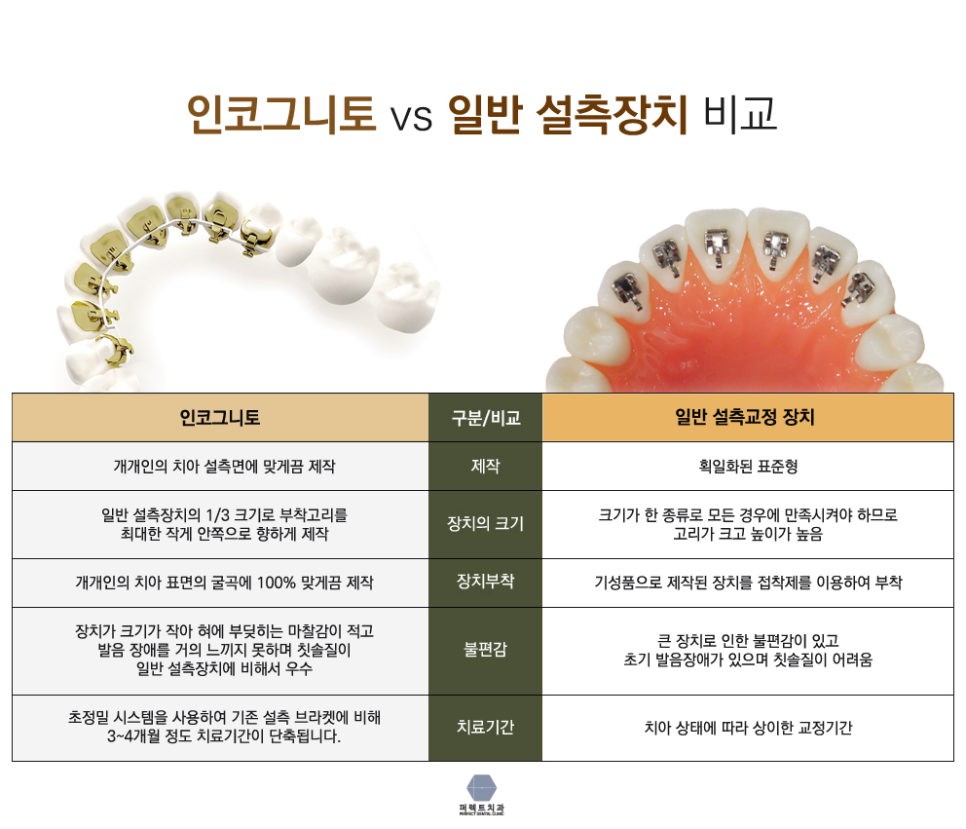 치아안쪽에 하는 설측교정^^ 관련 이미지 5