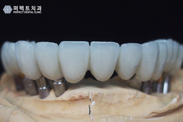 임플란트 건강보험 적용하면? 관련 이미지 7