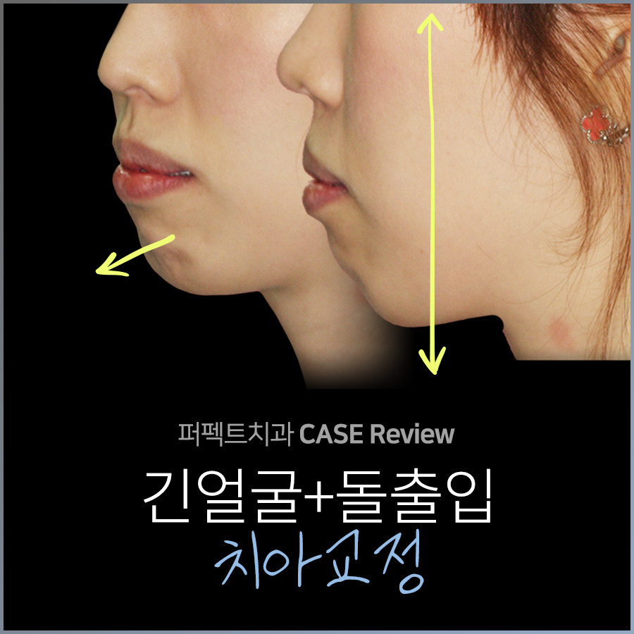 긴턱 치아교정, 턱변화 비교 관련 이미지 1