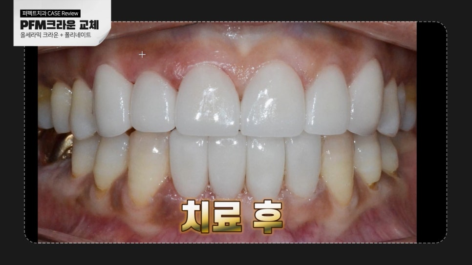 PFM크라운&rarr;라미네이트, 크라운 교체 케이스 관련 이미지 3