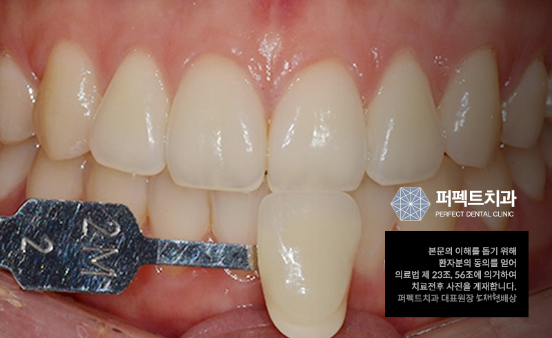 치아미백과정과 치아미백가격 알아보기 관련 이미지 2