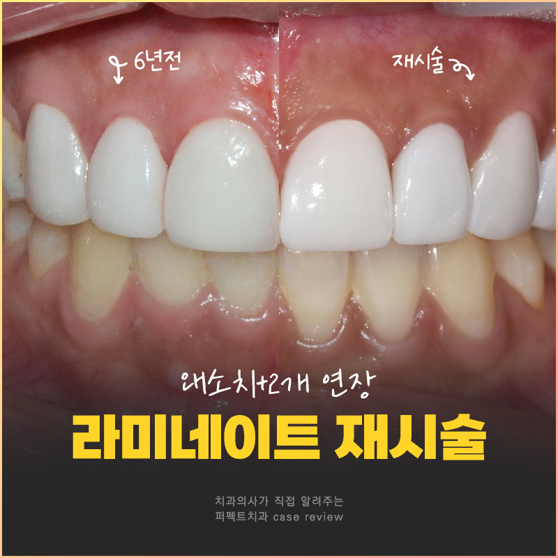 6년 전 라미네이트 교체&연장, 그 이유는?😯 관련 이미지 1