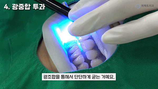 직접 받아본✨치아미백 과정① 관련 이미지 5