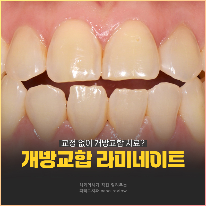 개방교합(open bite)을 라미네이트로 해결할 수 있을까? 관련 이미지 1