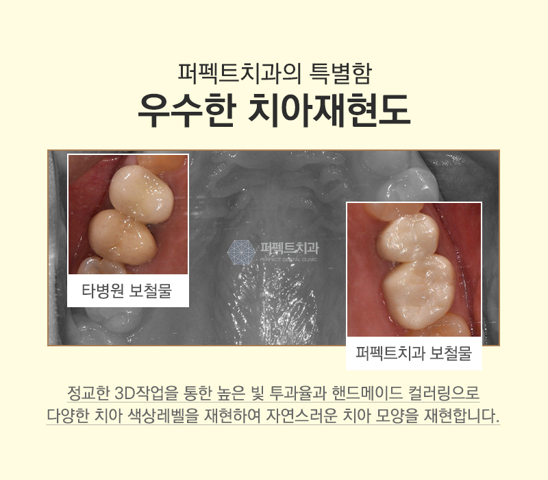 선릉역 어금니 지르코니아 가격 관련 이미지 8