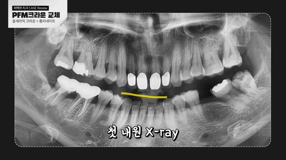PFM크라운&rarr;라미네이트, 크라운 교체 케이스 관련 이미지 5