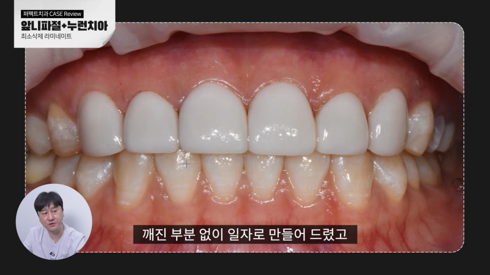 깨진앞니+나비치아 무삭제라미네이트 관련 이미지 6