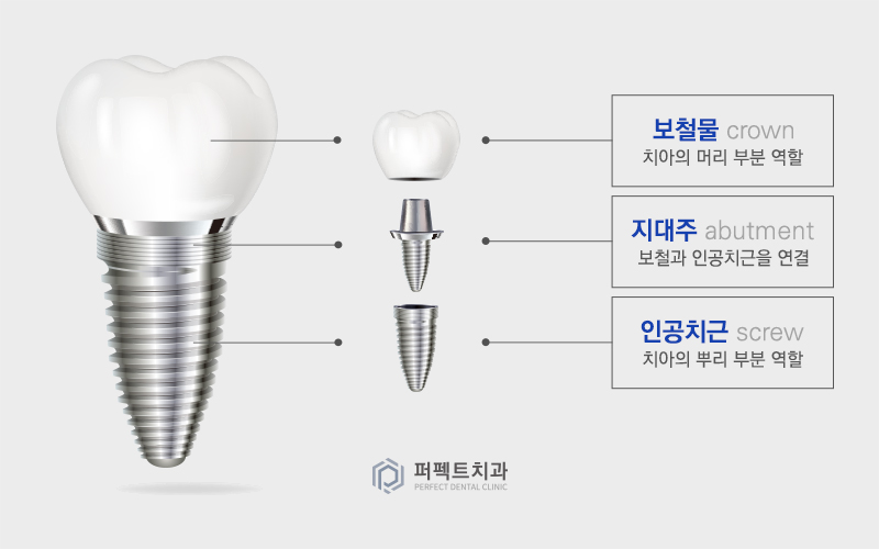 컴퓨터 분석을 통한 임플란트 관련 이미지 5