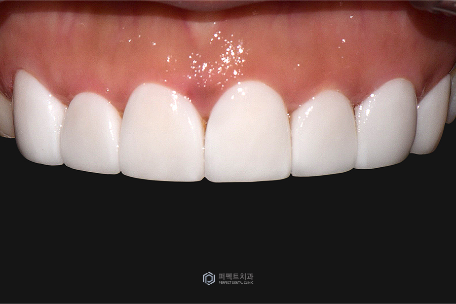 라미네이트 디자인👄｜치과의사가 고른 것vs환자가 고른 것, 어떤 걸로? 관련 이미지 6