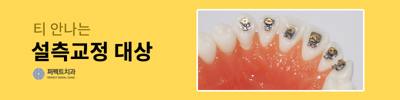 티안나는교정, 설측교정 시작! 관련 이미지 2