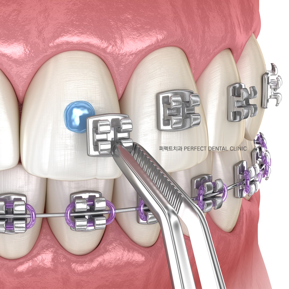 라미네이트 후 치아교정 가능한가요? 관련 이미지 4