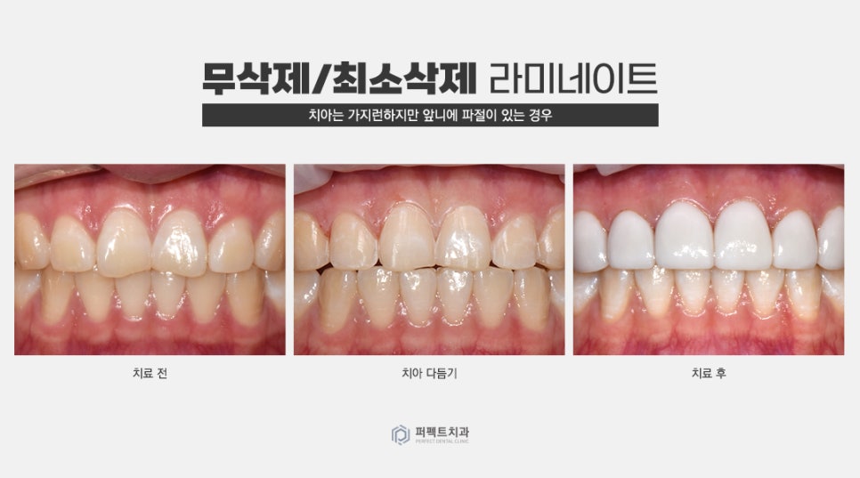 무삭제 라미네이트 추천 및 가능한 케이스 확인하기 관련 이미지 2