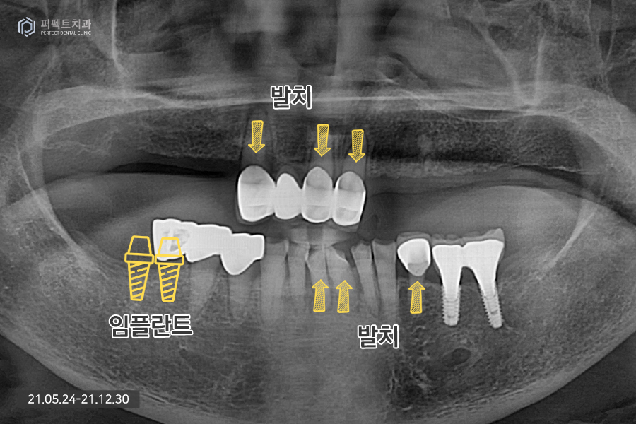 치아가 하나도 없을 때 필요한 전악임플란트😬 관련 이미지 5
