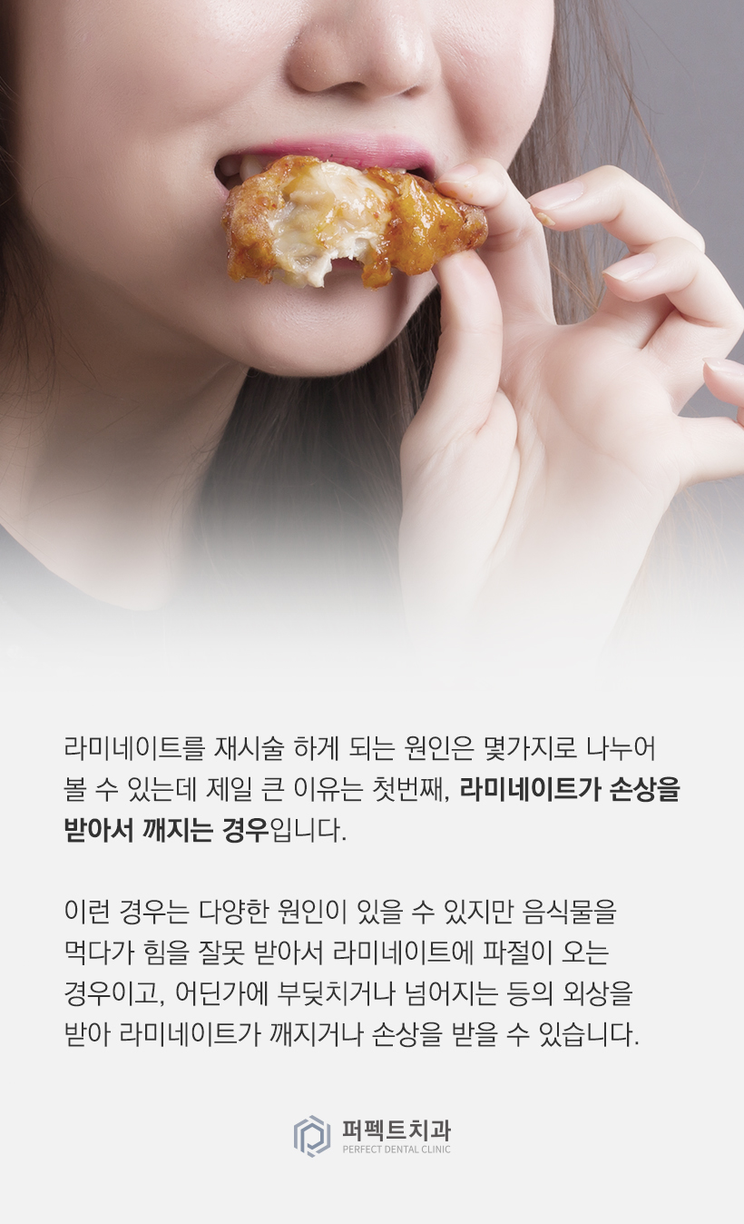 라미네이트 재시술을 하게 되는 이유는? 관련 이미지 1