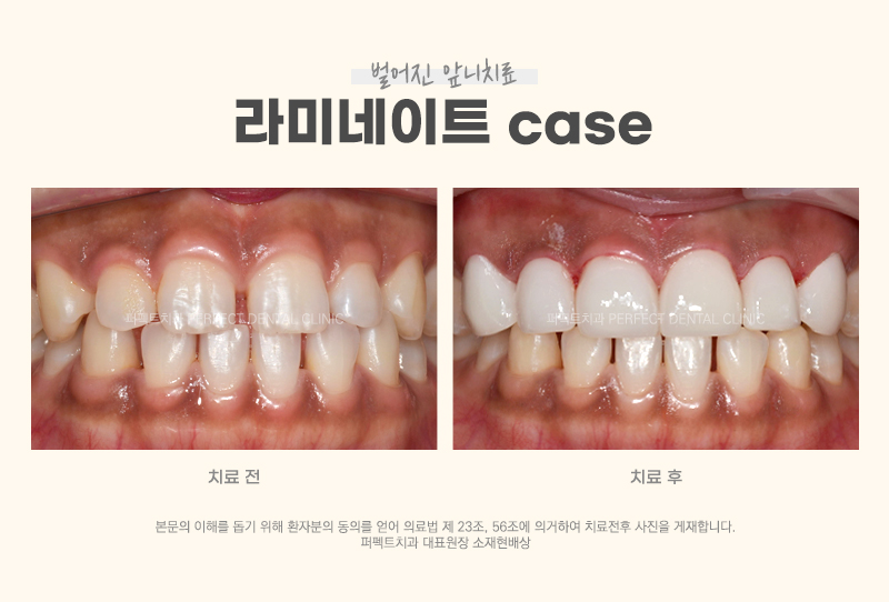 벌어진 앞니를 치료하는 다양한 방법 관련 이미지 3