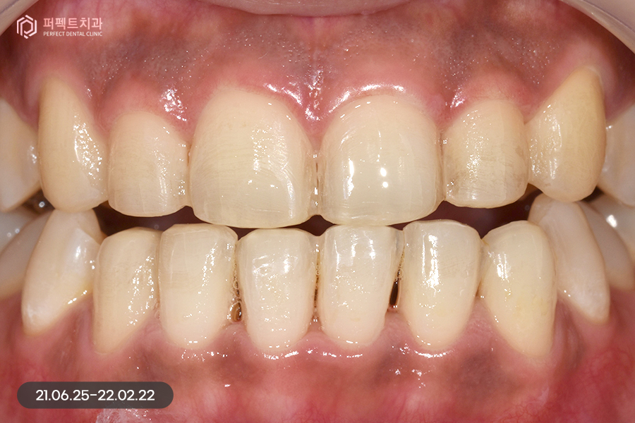 삐뚠 치아도 최소삭제가 가능하게👌🏻 교정 후 폴리네이트 관련 이미지 7