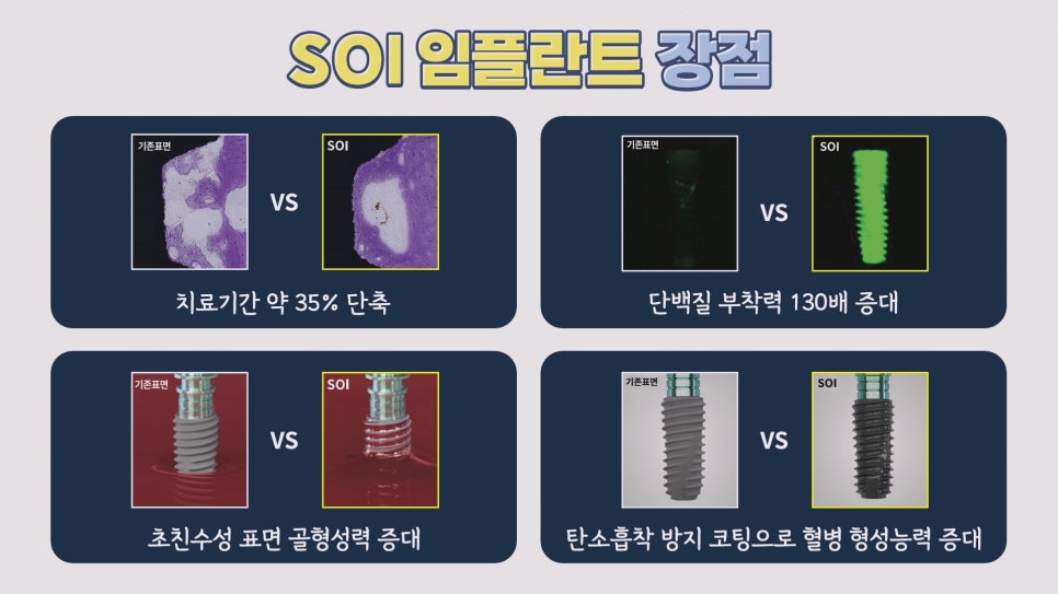 임플란트 종류③|BA, SOI 임플란트의 장점은? 관련 이미지 1