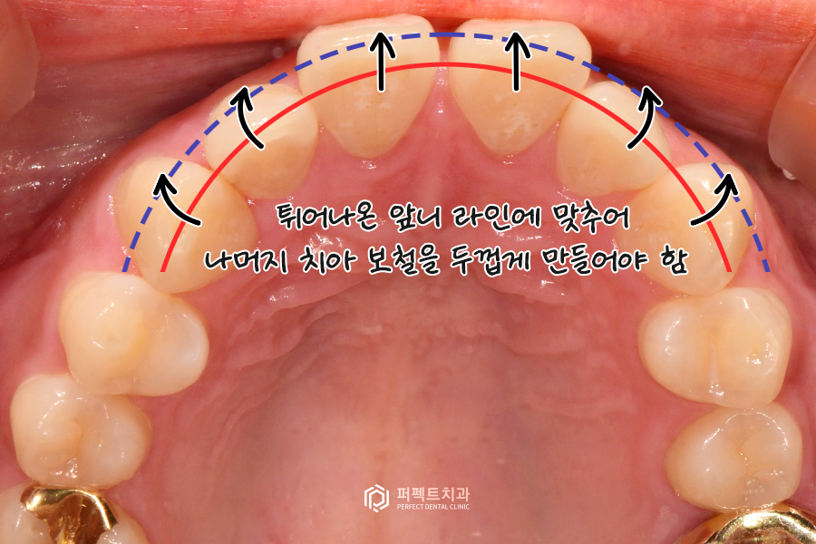 앞니 돌출 있는데 폴리네이트로 극복 가능..?🤔 관련 이미지 4