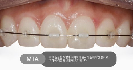 고민되는 부분만 집중적으로 부분교정 하자! 관련 이미지 2