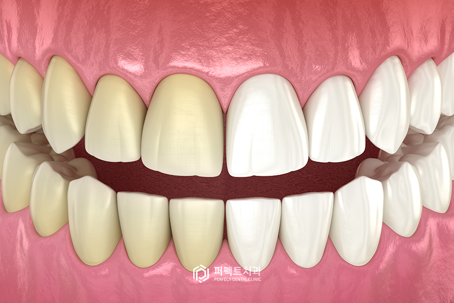 앞니 반점치, 치료 할 수 있는 방법은? 관련 이미지 4