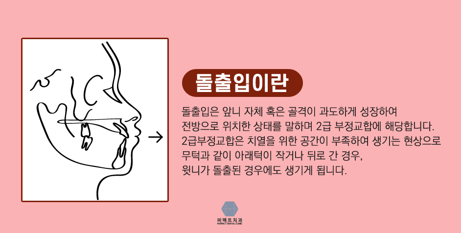 돌출입교정 퍼펙트치과 관련 이미지 2