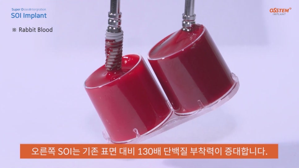 임플란트 종류|좋은 임플란트 고르는 방법은? 관련 이미지 4