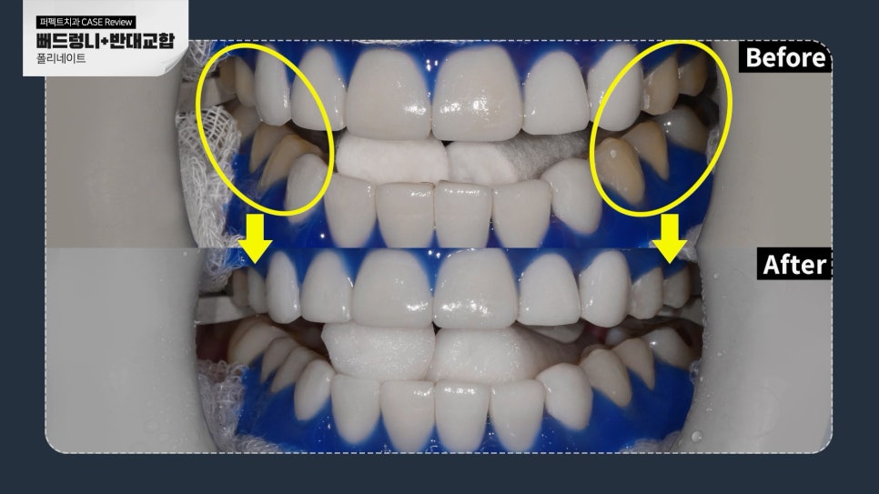 앞니 폴리네이트+치아미백 치료 관련 이미지 8