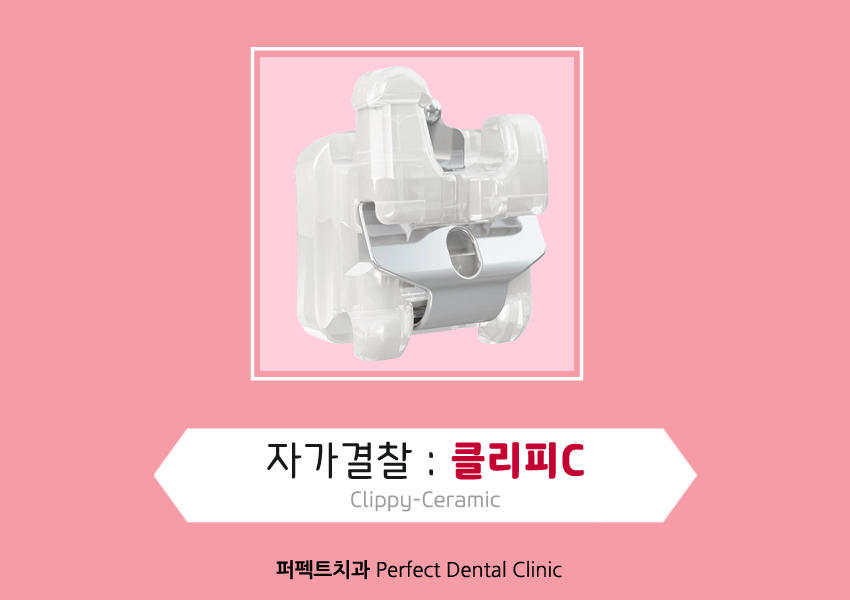 부정교합 치아교정은~? 관련 이미지 4