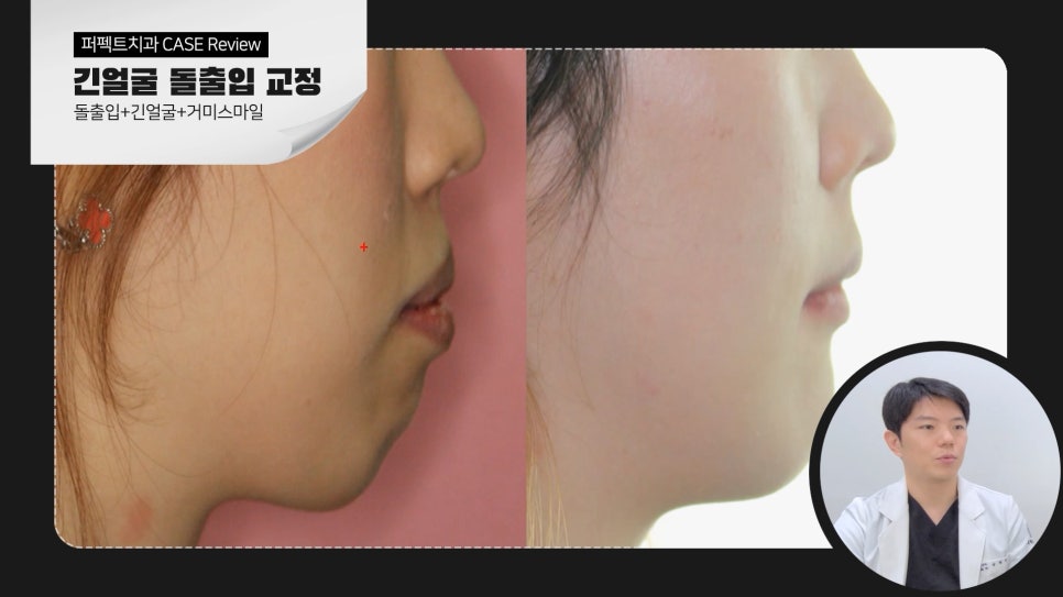 긴얼굴+돌출입+거미스마일 비수술교정case 관련 이미지 5
