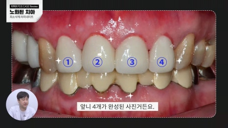 노화된 치아, 최소삭제라미네이트 관련 이미지 3