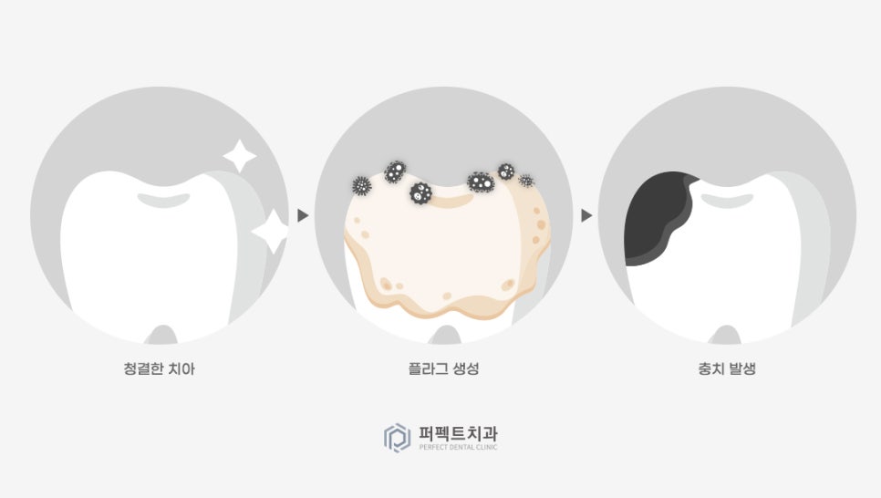 미룰수록 어려운 충치치료, 초기에 치료해요! 관련 이미지 2