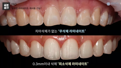 떨어진 라미네이트 재시술 가능? 관련 이미지 4