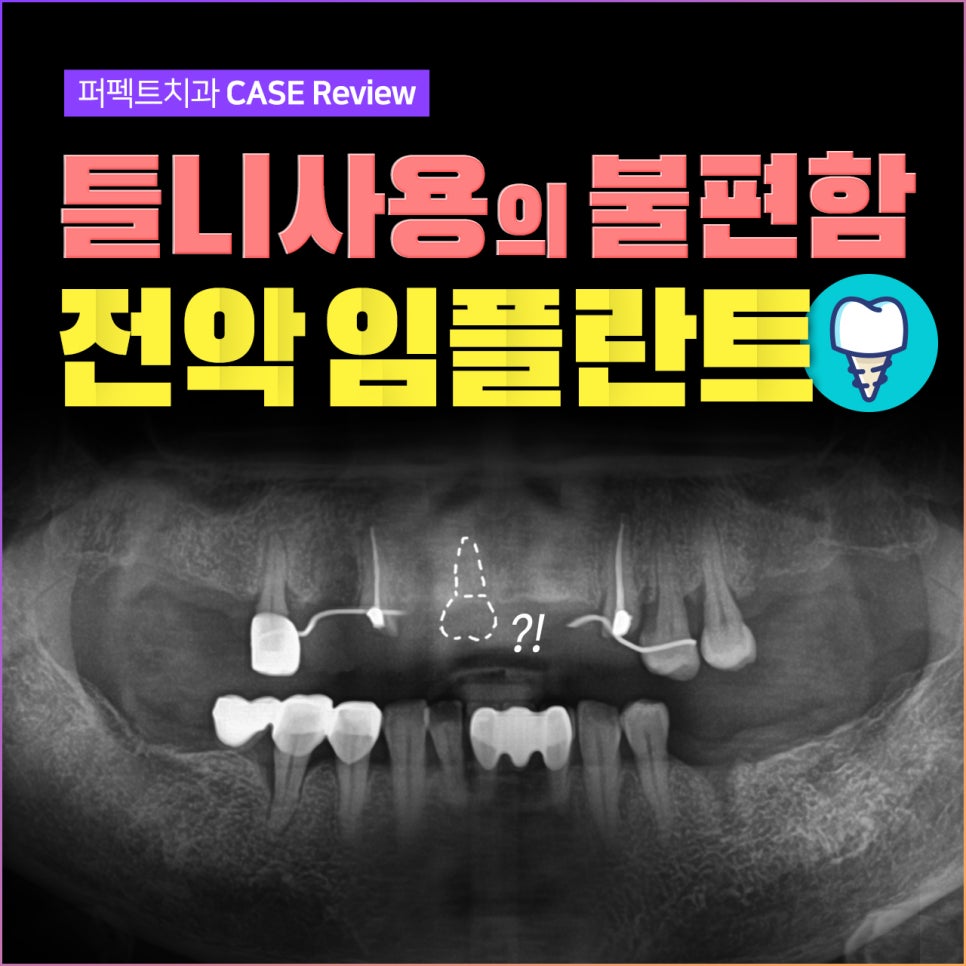 틀니사용이 불편한가요? 전악임플란트로 교체했습니다. 관련 이미지 1