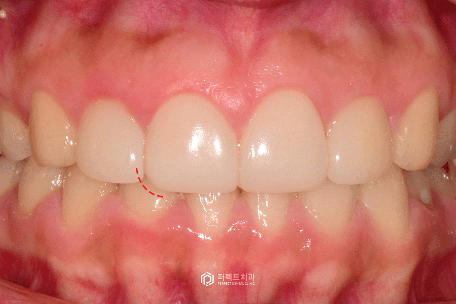 3일만에 라미네이트 교체를 결정한 이유는?😲 관련 이미지 3