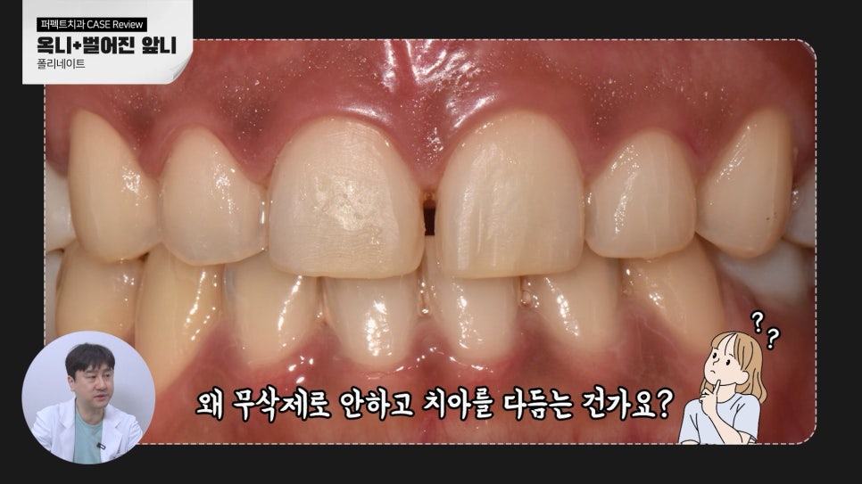 벌어진앞니 무삭제라미네이트 케이스 관련 이미지 3