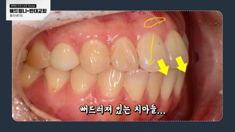 반대교합, 뻐드러진 치아 라미네이트 가능?! 관련 이미지 3