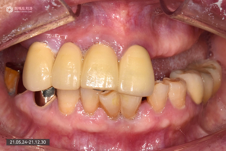 치아가 하나도 없을 때 필요한 전악임플란트😬 관련 이미지 2
