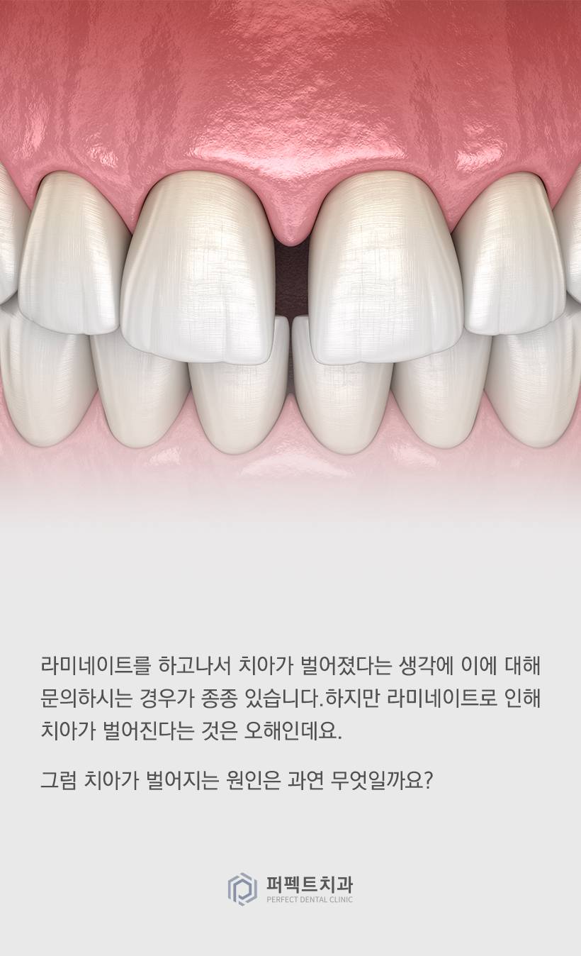 라미네이트를 했는데 앞니가 벌어졌어요! 관련 이미지 1