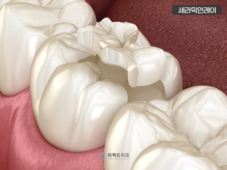 충치치료 인레이, 어떤 경우에? 관련 이미지 2