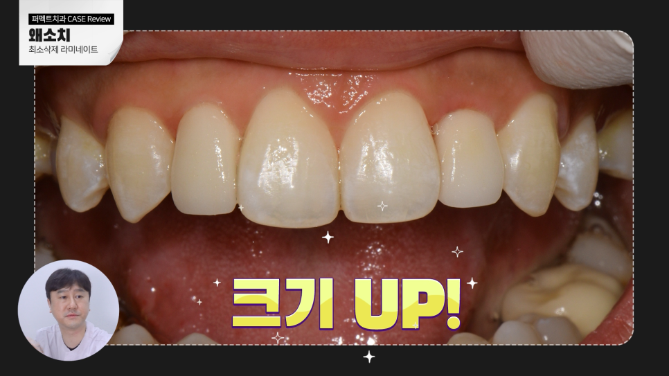 왜소치 라미네이트? 교정? 간단한 치료방법은 관련 이미지 5
