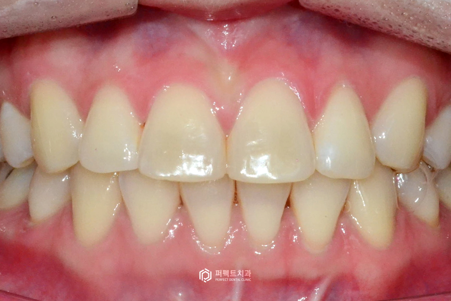 치아 모양 때문에 뻐드러져 보일 수 있다? 관련 이미지 2