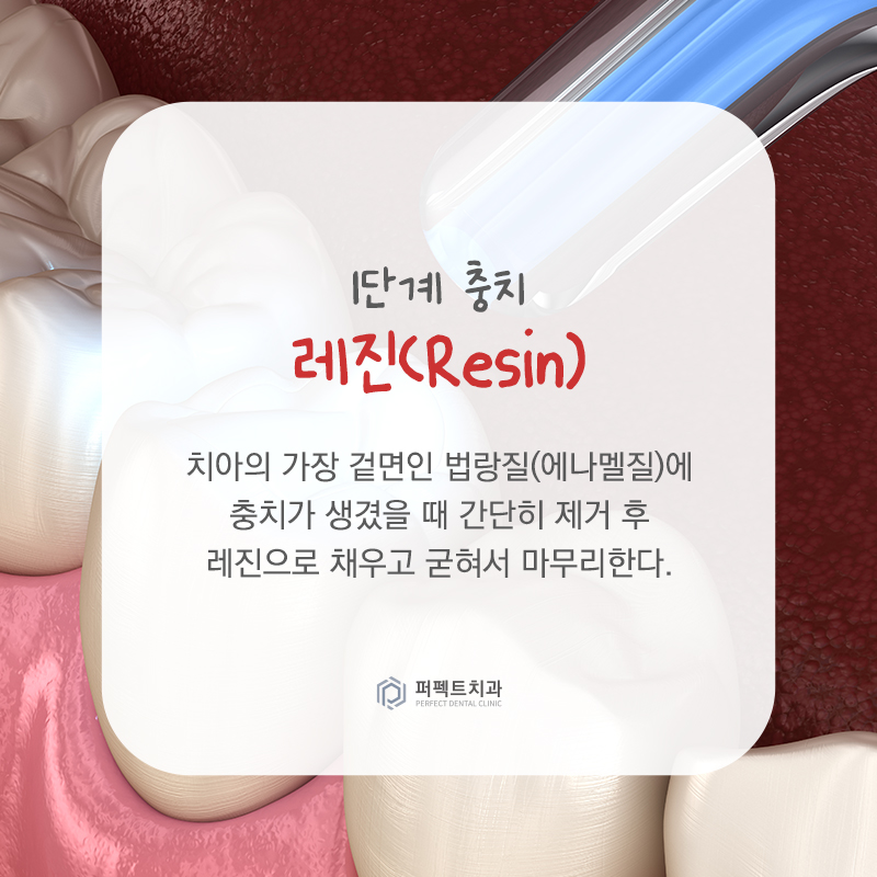 충치치료 단계와 치료방법 알아보기 관련 이미지 3