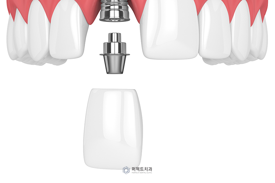 임플란트 후 임시치아, 임시틀니① 관련 이미지 4