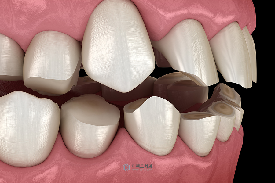 치아에 금이 갔어요|예방법과 치료방법은? 관련 이미지 1