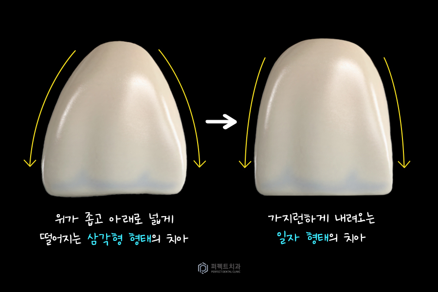 레진으로 변색+마모된 치아, 개선 방법은? 관련 이미지 3