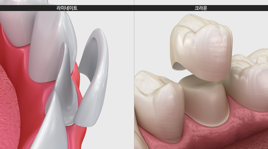 치아도 부식이 된다? 부식의 원인과 치료방법! 관련 이미지 3