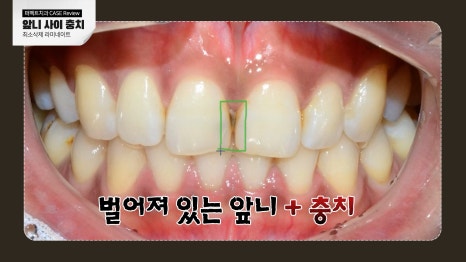 앞니 사이 충치치료와 폴리네이트 관련 이미지 2