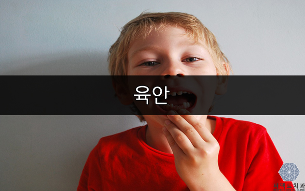 [퍼펙트치과] 충치 증상은 어떻게 알까? 관련 이미지 3