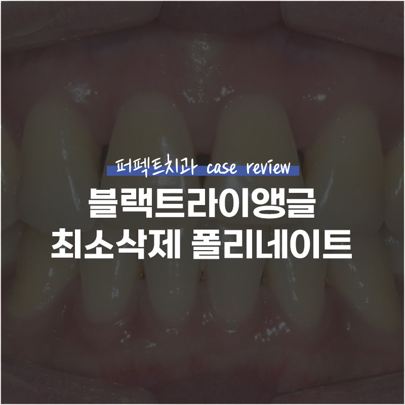 블랙트라이앵글+노란치아 폴리네이트 case 관련 이미지 1